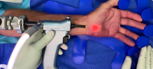 Endoscopic Carpal Tunnel Release