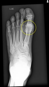 Big toe arthritis