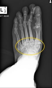 midfood arthritis